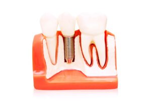 Good Habits to Practice When You Have Dental Implants