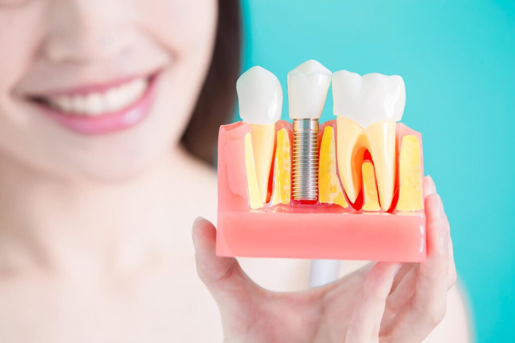 Top Dental Implant Myths