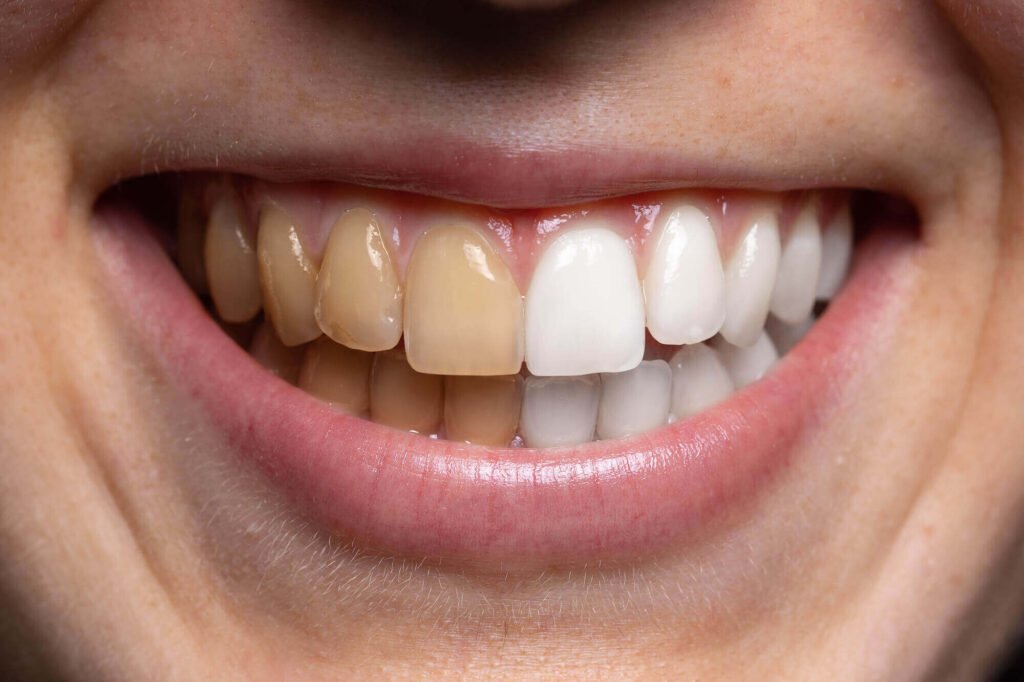 How to Prevent Teeth Stains