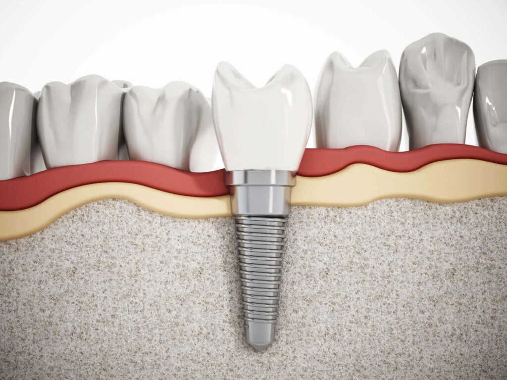 Habits That Hurt Your Dental Implants