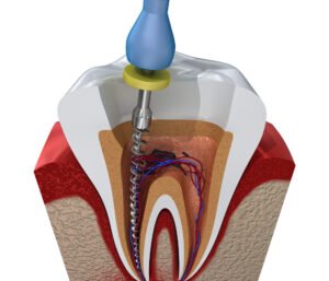 Root Canal Myths You Should Stop Believing 