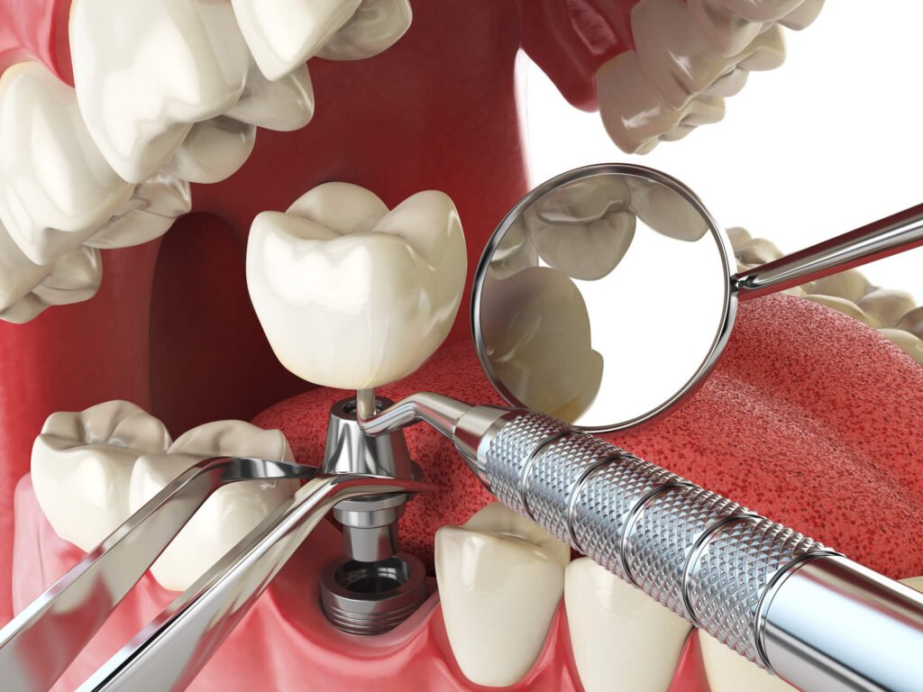 a closer look at Dental Implants in Cameron Park