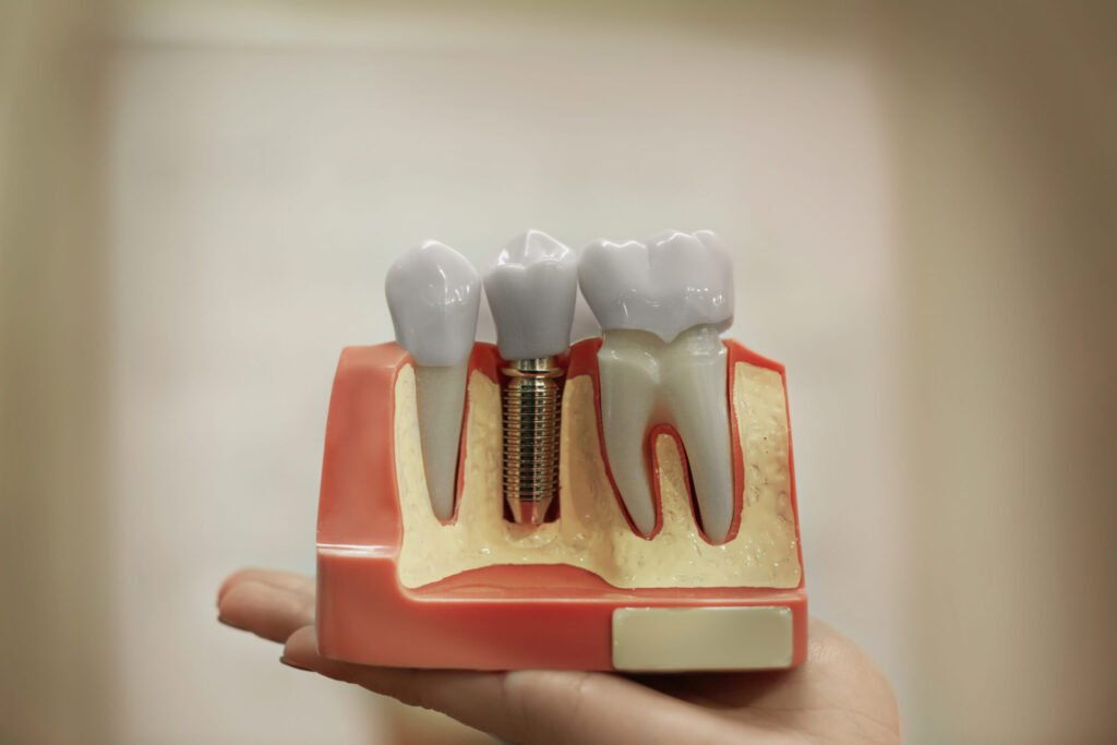 Most Asked Questions About Dental Implant Surgery Aftercare