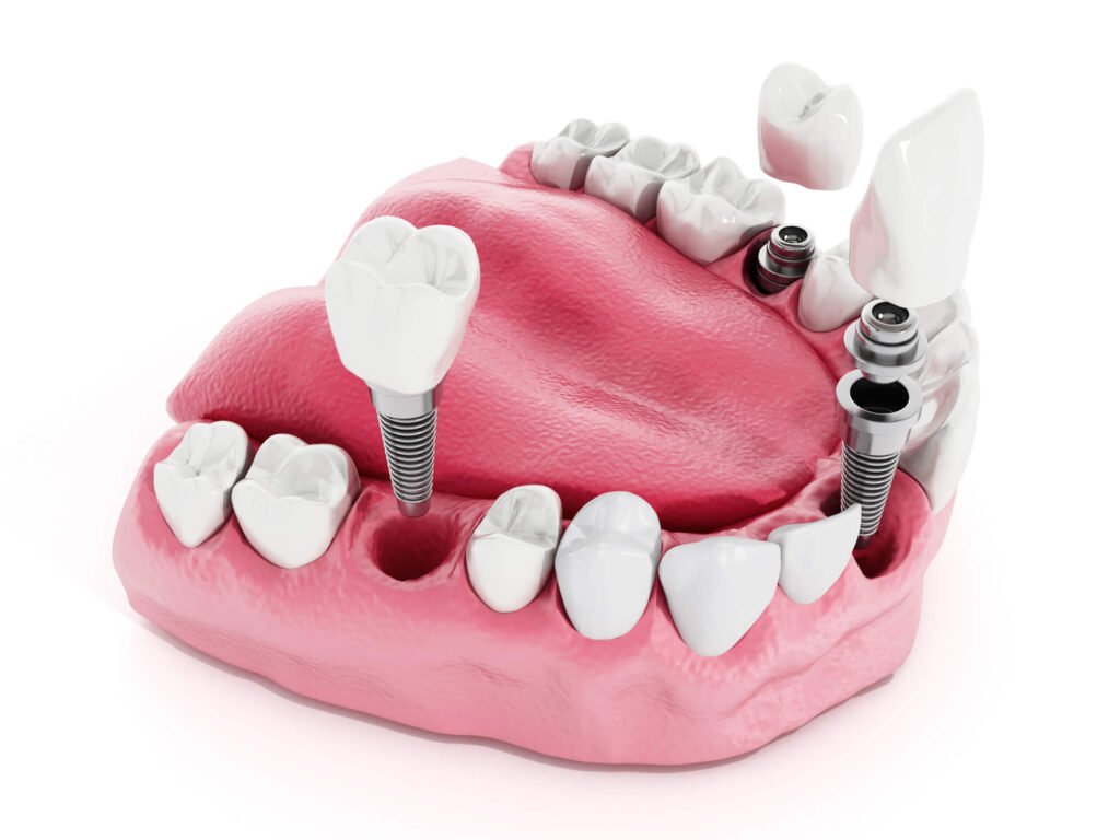 dental Implants diagram Placerville CA 