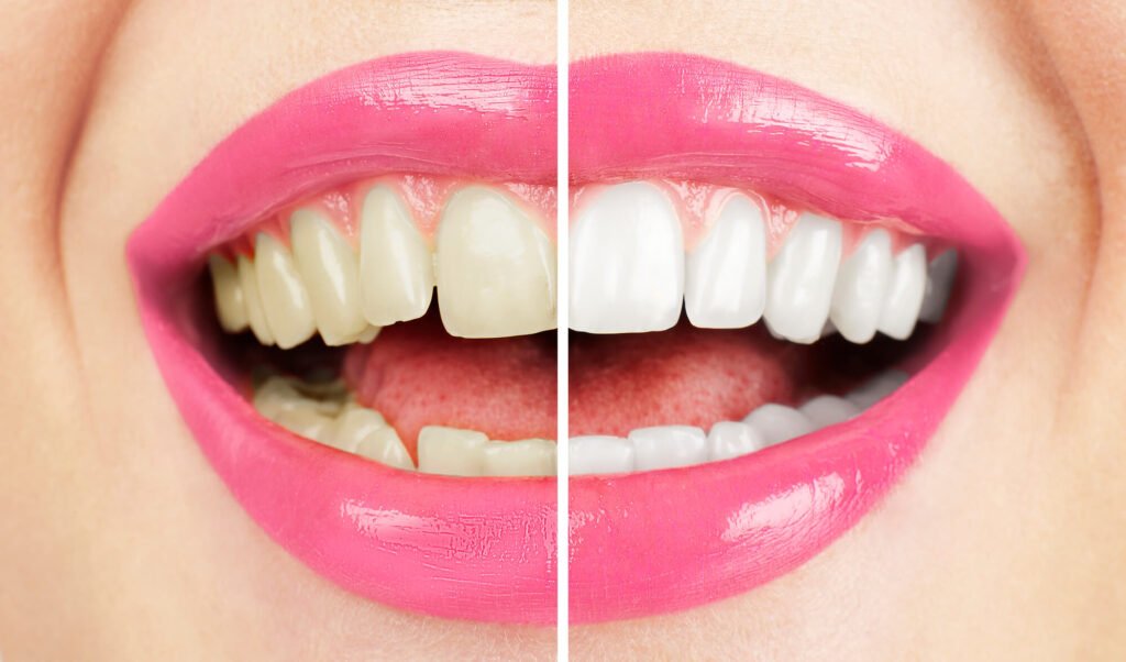 Before and after Teeth Whitening Cameron Park 