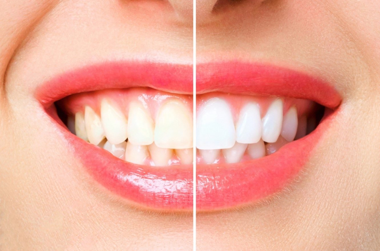 a person's teeth before and after whitening