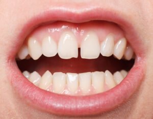Family Dentist in Placerville CA examines gapped teeth
