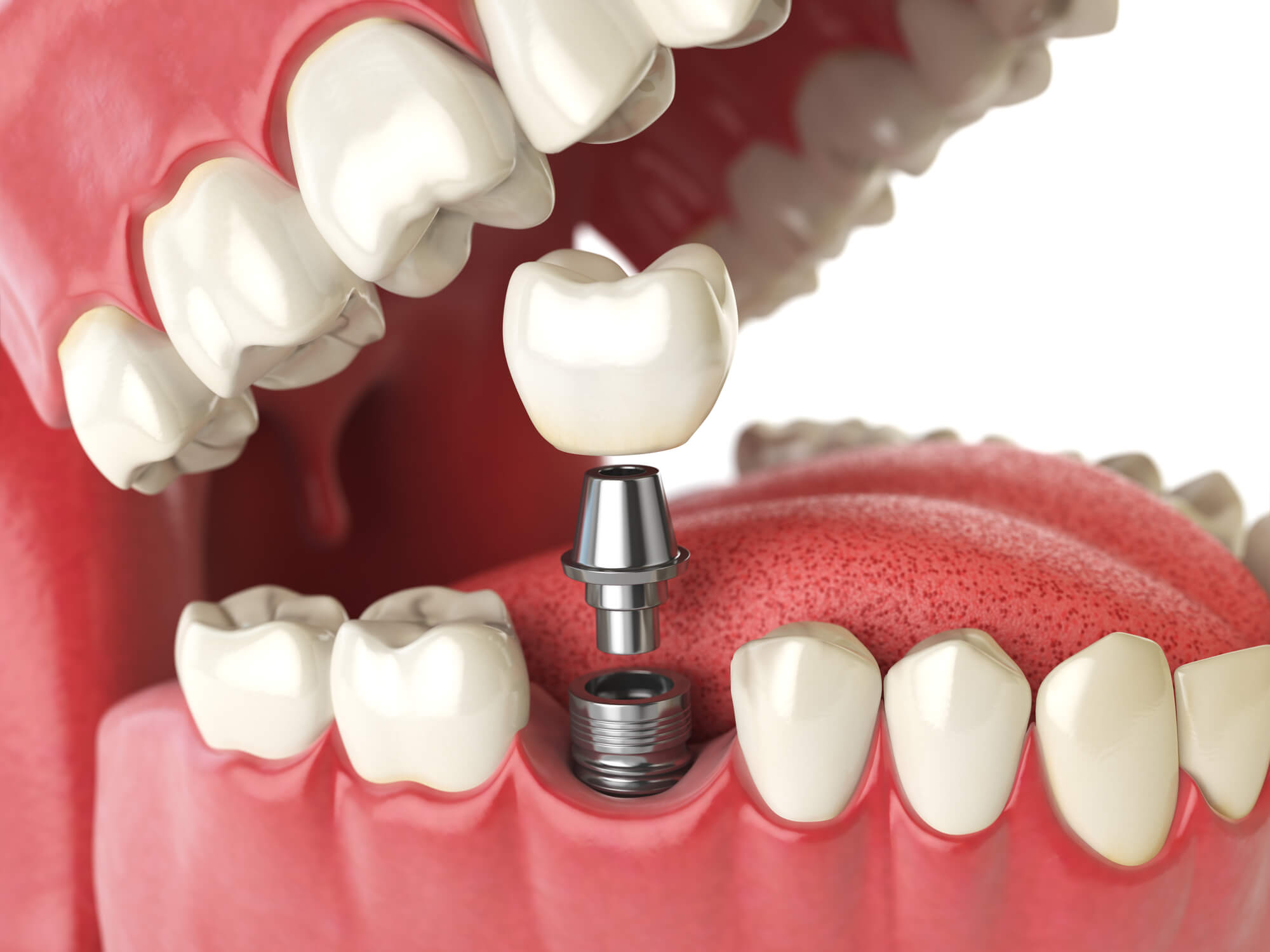 A Closer Look At El Dorado Hills Dental Implants