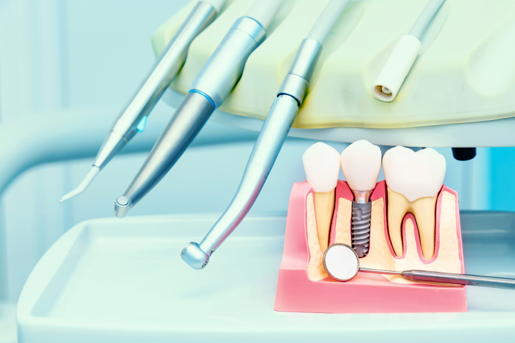 Dental Implants - Forest Ridge Dental Group