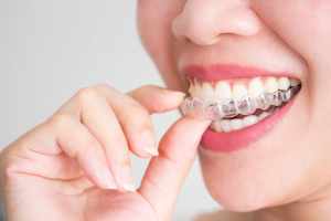 10 Cool Facts About Invisalign® - Forest Ridge Dental Group