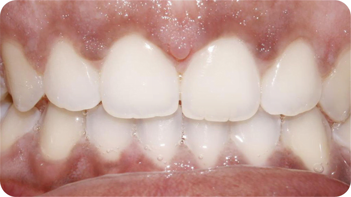 close up of teeth after invisalign procedure