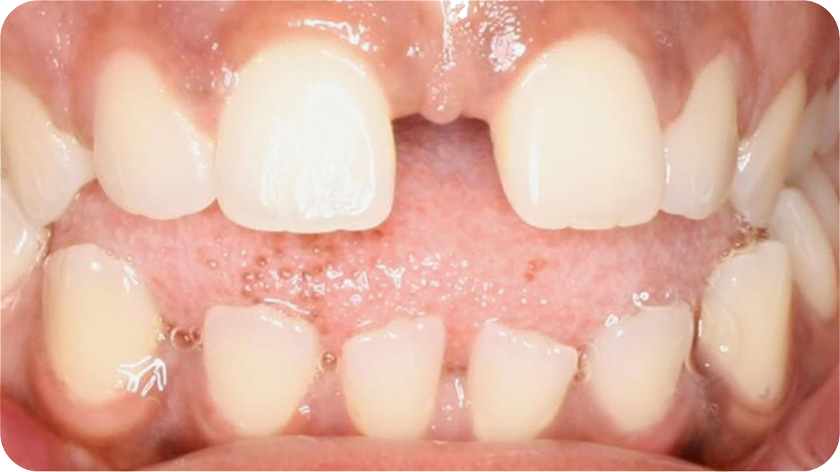 close up of teeth before invisalign procedure