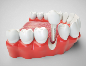 a model of teeth with a dental implant