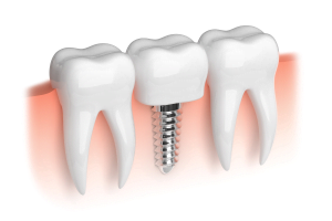 a row of teeth with a dental implant